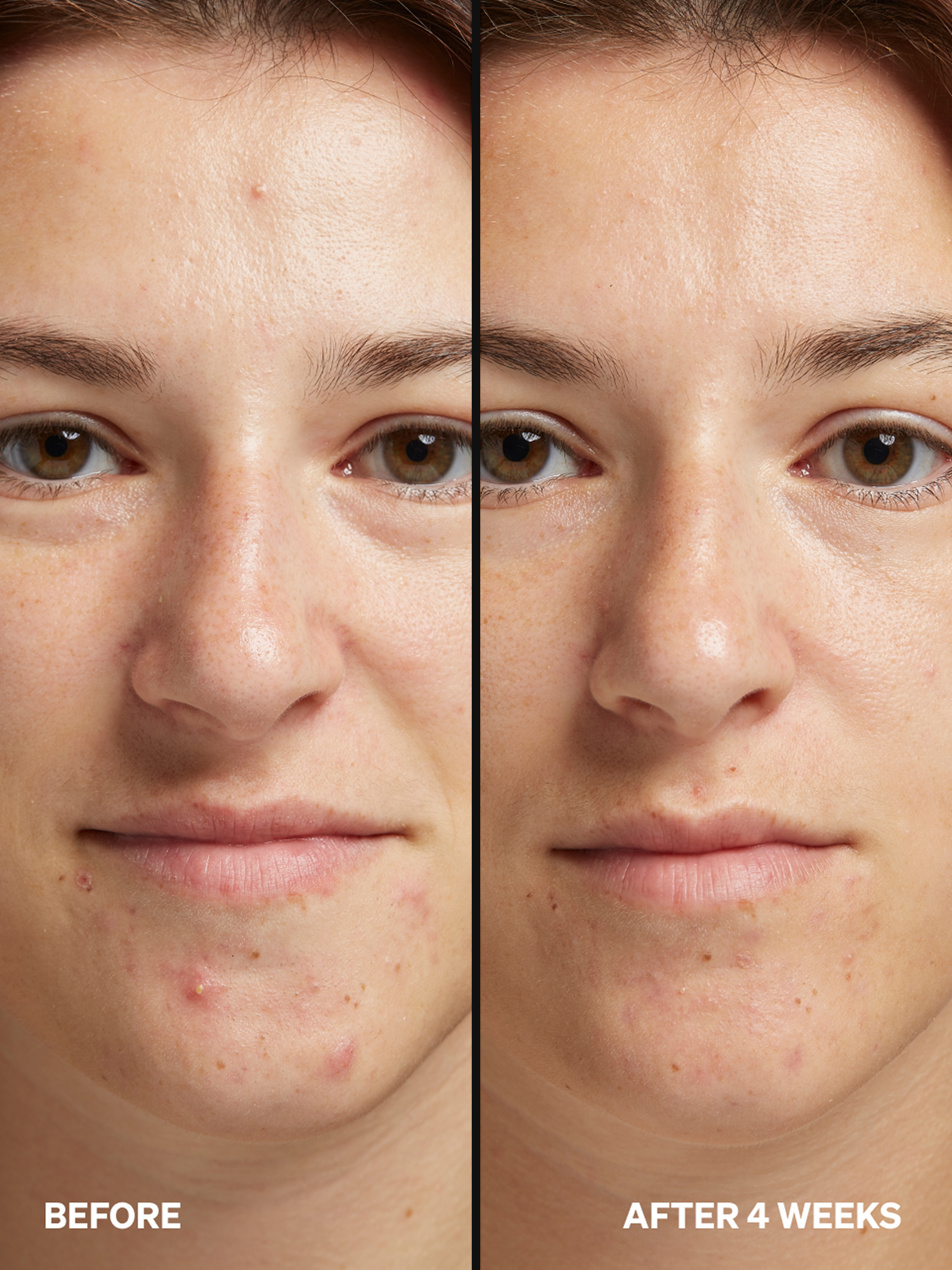 PAD Azelaic 5% - Onélogy